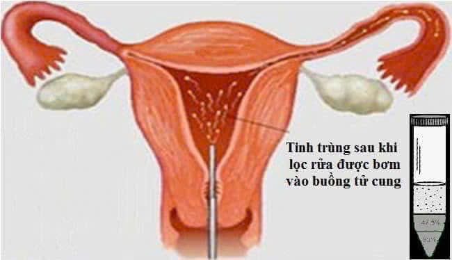 BƠM TINH TRÙNG VÀO BUỒNG TỬ CUNG (IUI) – GIẢI PHÁP HỖ TRỢ SINH SẢN AN TOÀN VÀ HIỆU QUẢ