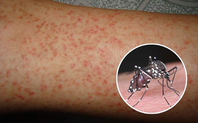 WHO: SỐT XUẤT HUYẾT GIA TĂNG TRÊN TOÀN CẦU
