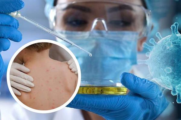 Bệnh đậu mùa khỉ: Đường lây truyền và cách phòng ngừa cần làm ngay