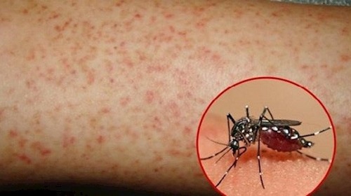 Hỏi đáp về bệnh sốt xuất huyết Dengue