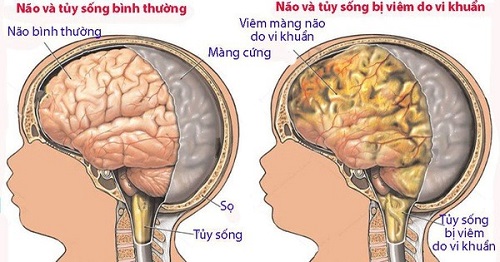 Cần cảnh giác với viêm não cấp ở trẻ