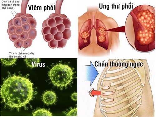 Tràn dịch màng phổi: Nguyên nhân, biểu hiện và điều trị