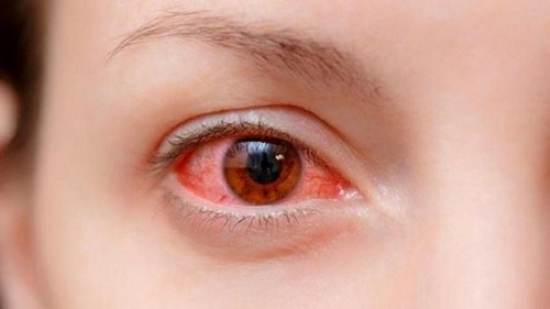 Thuốc uống, chườm mắt chữa đau mắt đỏ hiệu quả