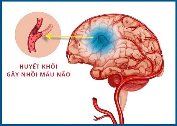 Ai có nguy cơ đột quỵ nhồi máu não?
