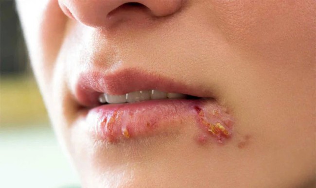 Thuốc điều trị bệnh chốc mép