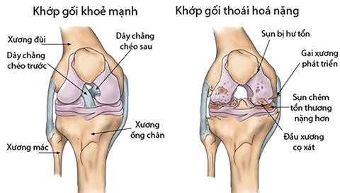 Điều trị gai khớp gối cho người cao tuổi