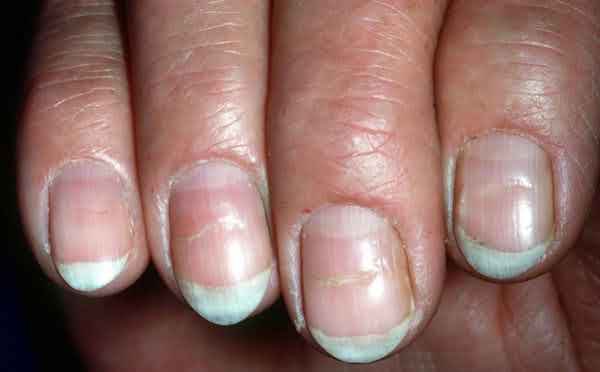 6 dấu hiệu trên móng tay cảnh báo vấn đề sức khỏe nghiêm trọng