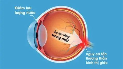 Thực phẩm tốt cho mắt và phòng ngừa tăng nhãn áp