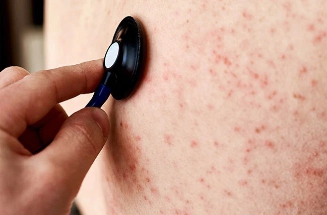 Nhiều trường hợp mắc rubella, dấu hiệu nào nhận biết bệnh sớm?