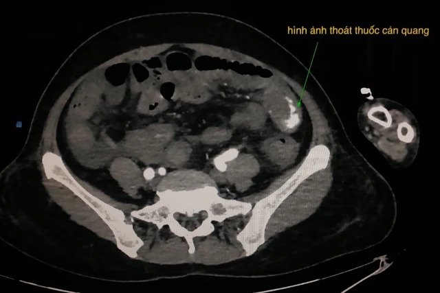 Xuất huyết tiêu hóa từ ruột non khiến bệnh nhân rối loạn đông máu