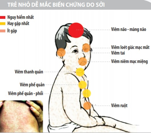 Bệnh Sởi và cách phòng tránh