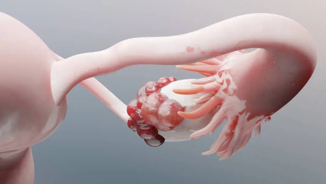 Thuốc điều trị ung thư buồng trứng