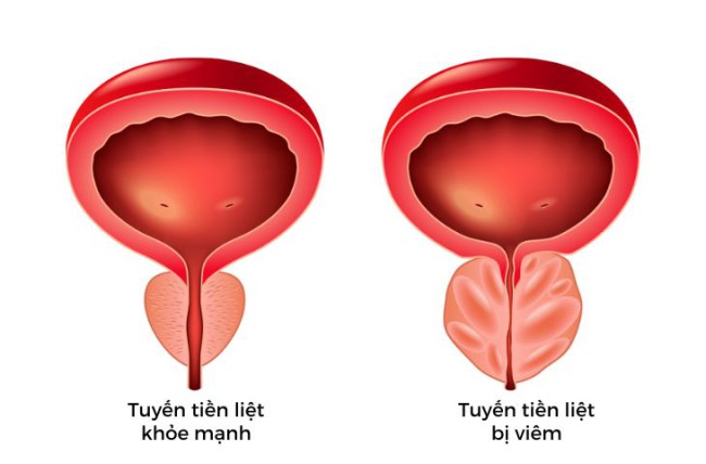 4 loại viêm tuyến tiền liệt phổ biến ở nam giới