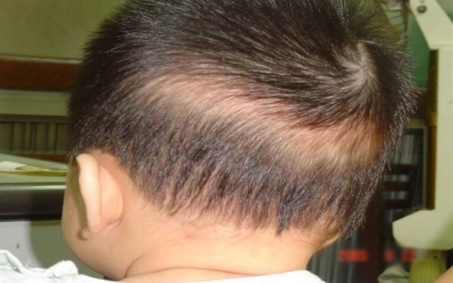 Trẻ bị rụng tóc hình vành khăn có đáng lo ngại?