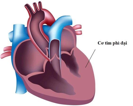 Cơ tim phì đại: Nguyên nhân, biểu hiện, cách điều trị và phòng bệnh