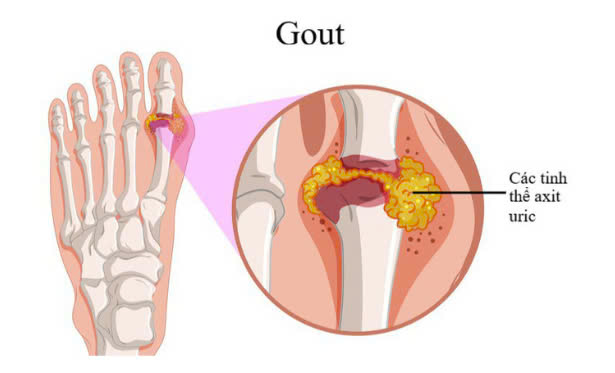10 dấu hiệu cảnh báo tăng axit uric vượt tầm kiểm soát
