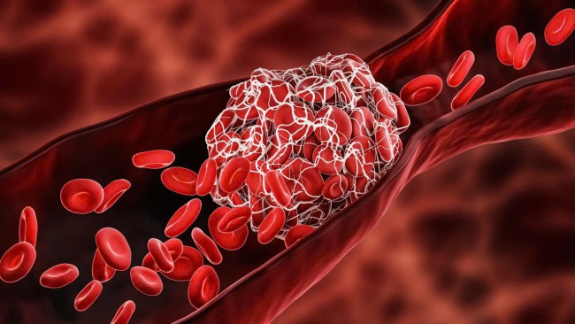 Thuốc điều trị hội chứng kháng thể kháng phospholipid
