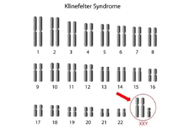 Hội chứng Klinefelter: Nguyên nhân, biểu hiện, cách điều trị và phòng bệnh