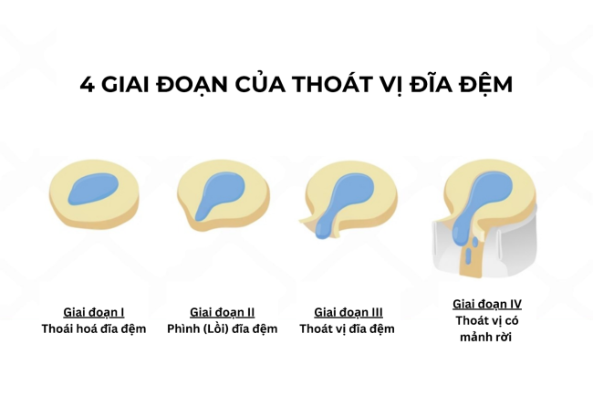 Nhận biết sớm các giai đoạn thoát vị đĩa đệm để điều trị hiệu quả