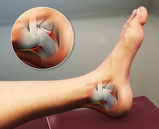 Hội chứng ống cổ chân: Nguyên nhân, biểu hiện, cách điều trị và phòng bệnh