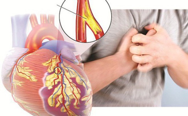 Câu hỏi thường gặp liên quan đến cơ tim phì đại