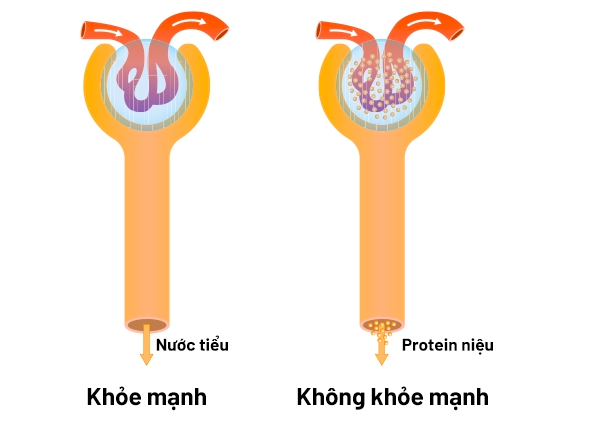Đạm niệu: Nguyên nhân, biểu hiện, cách điều trị và phòng bệnh