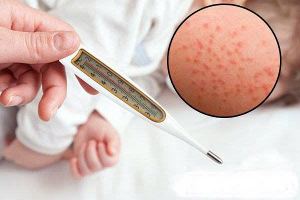 Khuyến cáo về cách bổ sung vitamin A cho trẻ mắc bệnh sởi