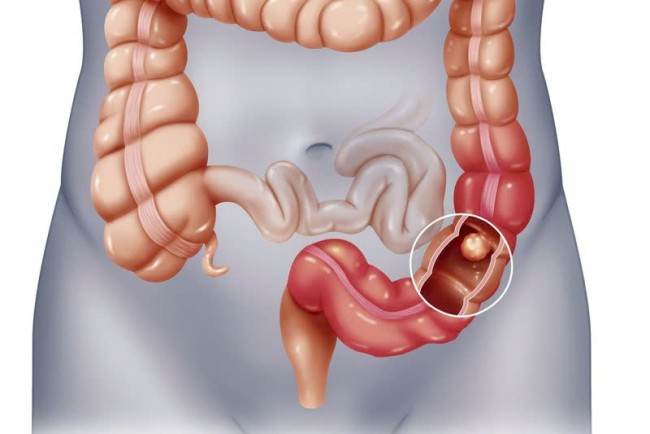 Chăm sóc dinh dưỡng cho bệnh nhân liệt ruột cần chú ý gì?