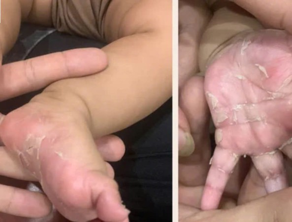 Bệnh giang mai bẩm sinh nguy hiểm thế nào?