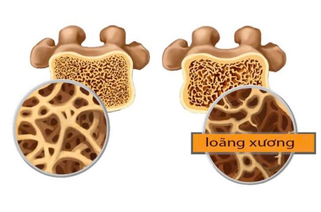 Những điều nên và không nên làm khi bị loãng xương