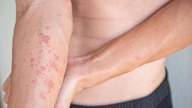Lichen Nitidus: Nguyên nhân, biểu hiện, cách điều trị và phòng bệnh
